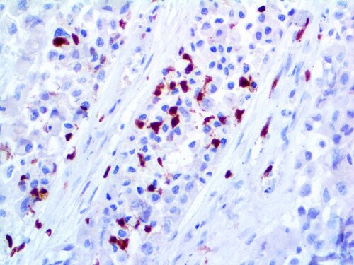 IHC of S100A9 on an FFPE Melanoma Tissue